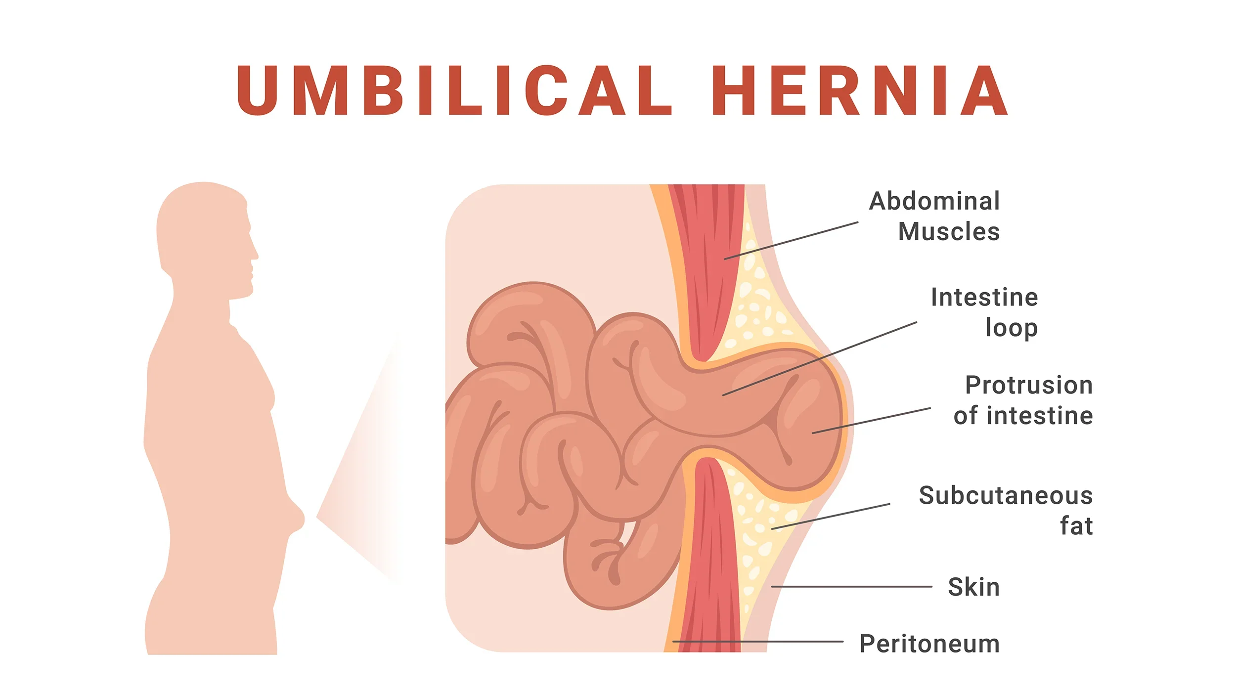 Diagram of an umbilical hernia showing abdominal muscles, intestine loop, protrusion of intestine, subcutaneous fat, skin, and peritoneum.