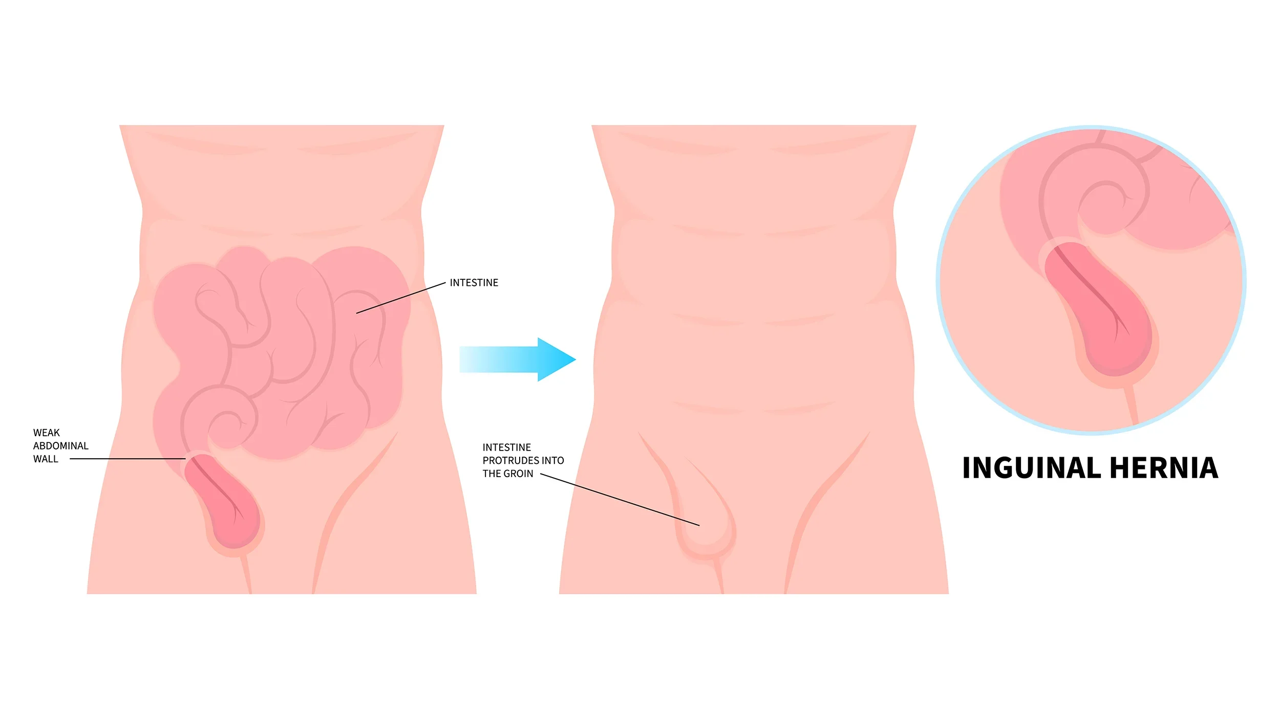 Diagram showing an inguinal hernia, illustrating the weakness in the abdominal wall where the intestine protrudes into the groin.