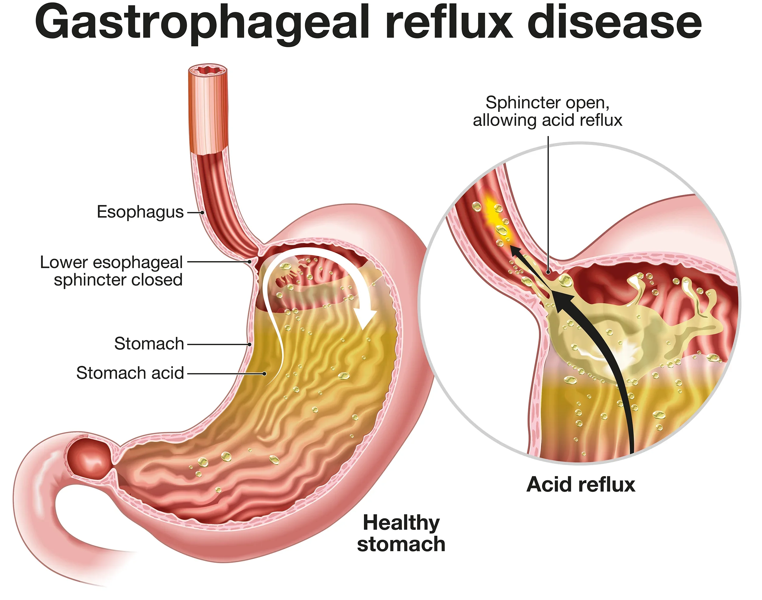 An illustration showing the stages of gastroesophageal reflux disease, with labels for esophagus, lower esophageal sphincter closed, stomach, stomach acid, healthy stomach, and acid reflux, depicting acid moving from the stomach back into the esophagus.