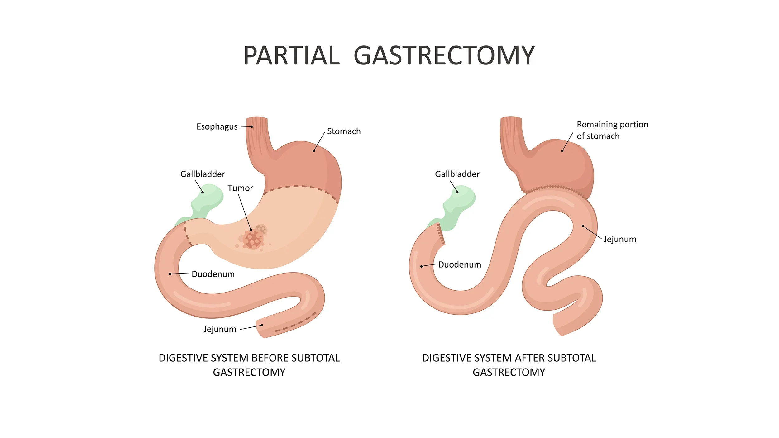 Comparison diagram of the human digestive system before and after partial gastrectomy, showing the removal of part of the stomach, with labels for esophagus, stomach, duodenum, jejunum, gallbladder, and tumor.