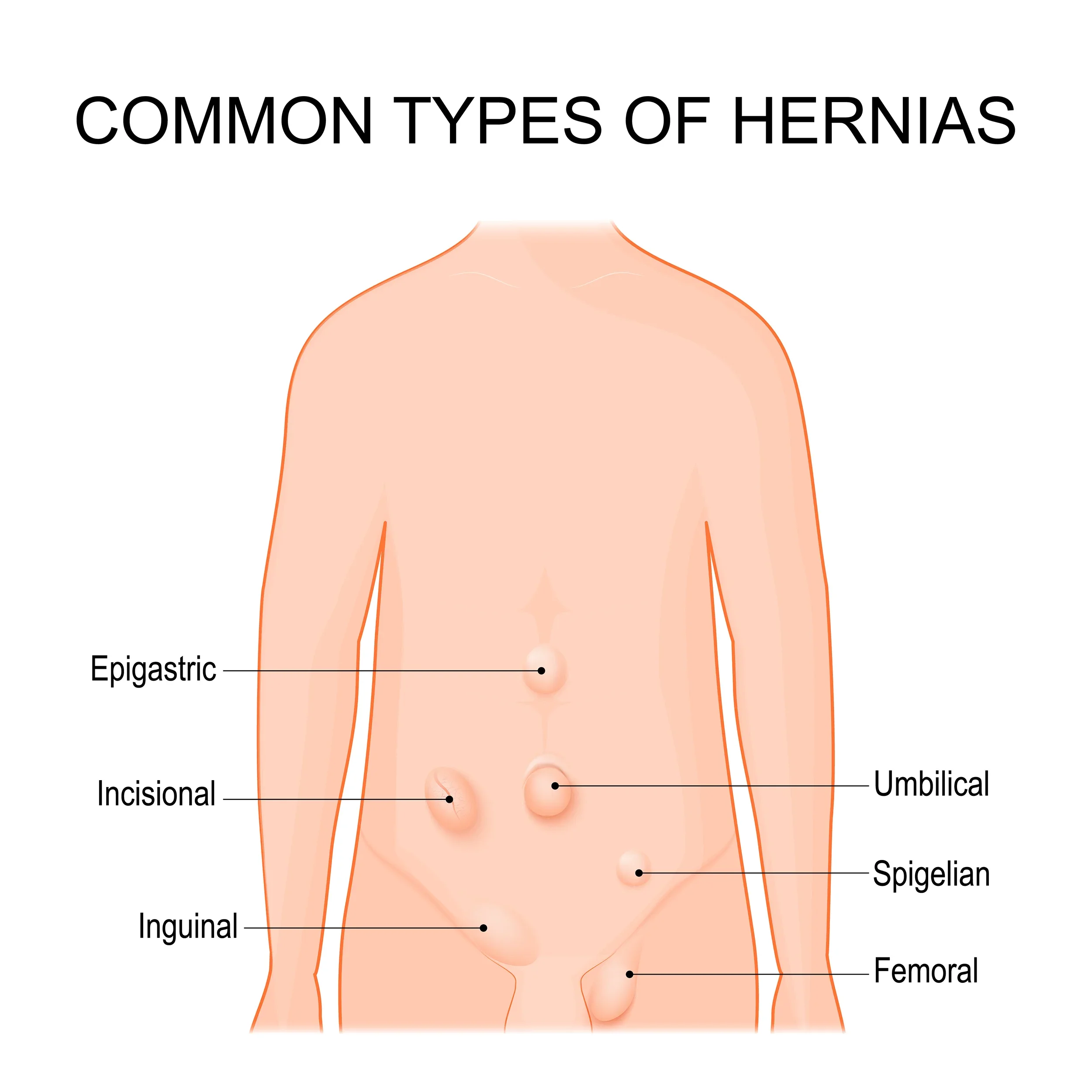 Diagram showing common types of hernias in the human pelvis area, including epigastric, incisional, inguinal, femoral, umbilical, spigelian, and diaphragmatic hernias.
