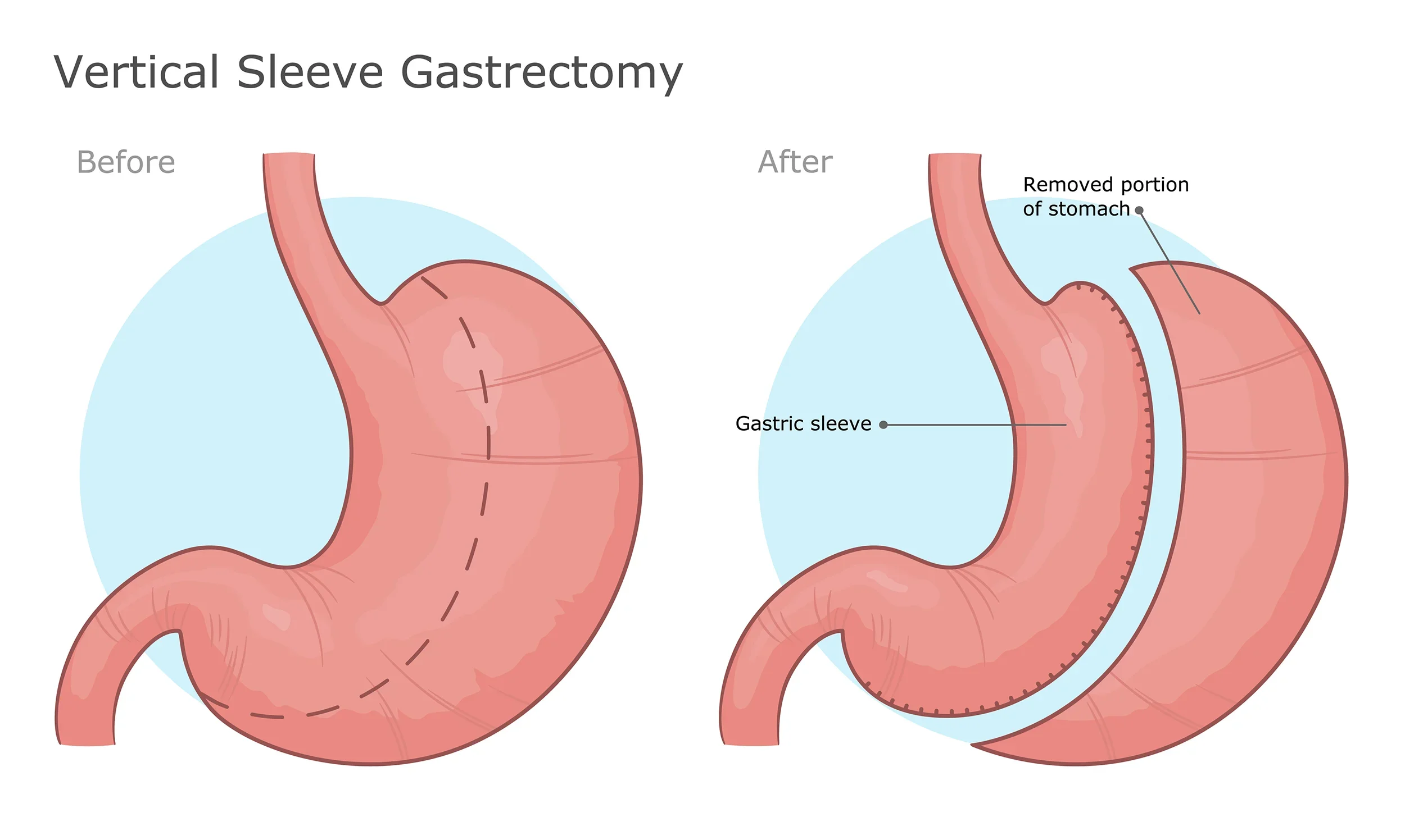 Illustration showing the before and after of a vertical sleeve gastrectomy, with labels indicating the removal of a portion of the stomach and the creation of a gastric sleeve.