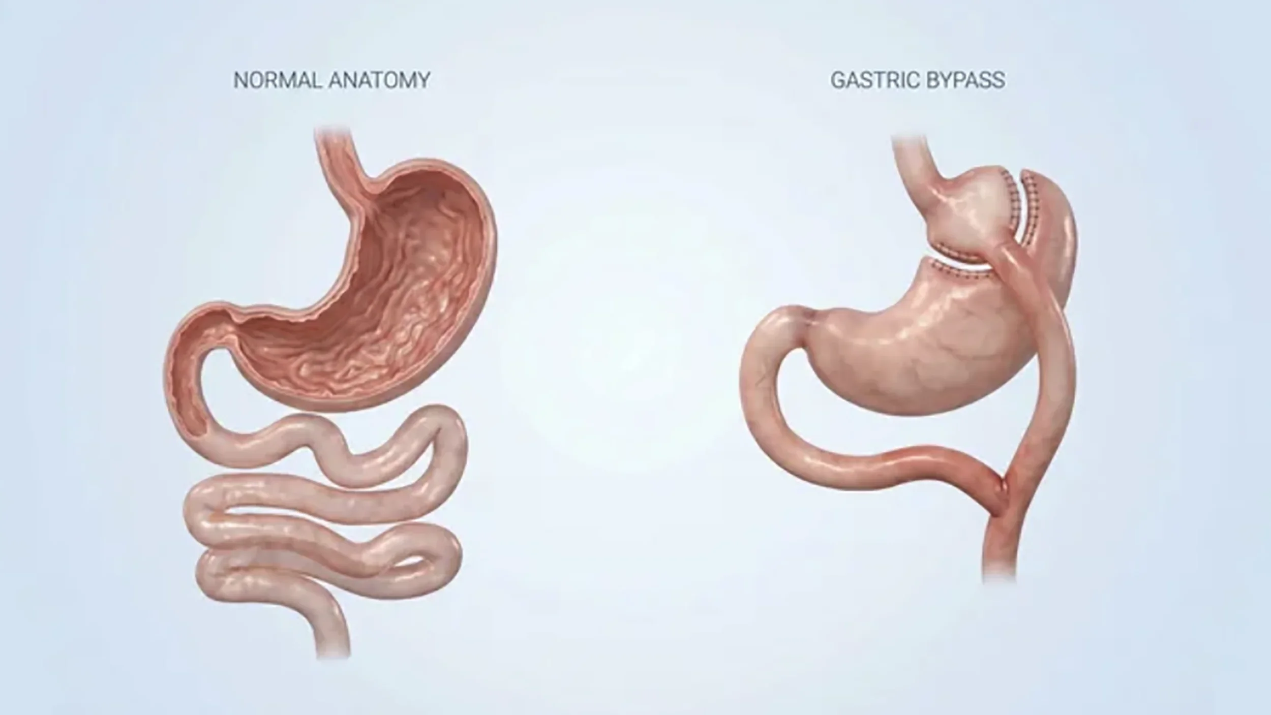 Comparison of normal stomach anatomy and stomach after gastric bypass surgery, showing the revision of stomach structure.