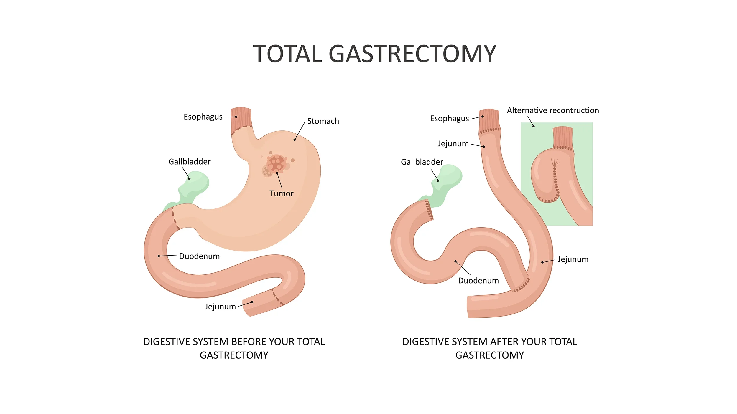Diagram comparing the digestive system before and after a total gastrectomy. The left side shows the stomach with a tumor, esophagus, duodenum, gallbladder, and jejunum. The right side depicts an alternative reconstruction after removal of the stomach, with the esophagus attached to the jejunum.