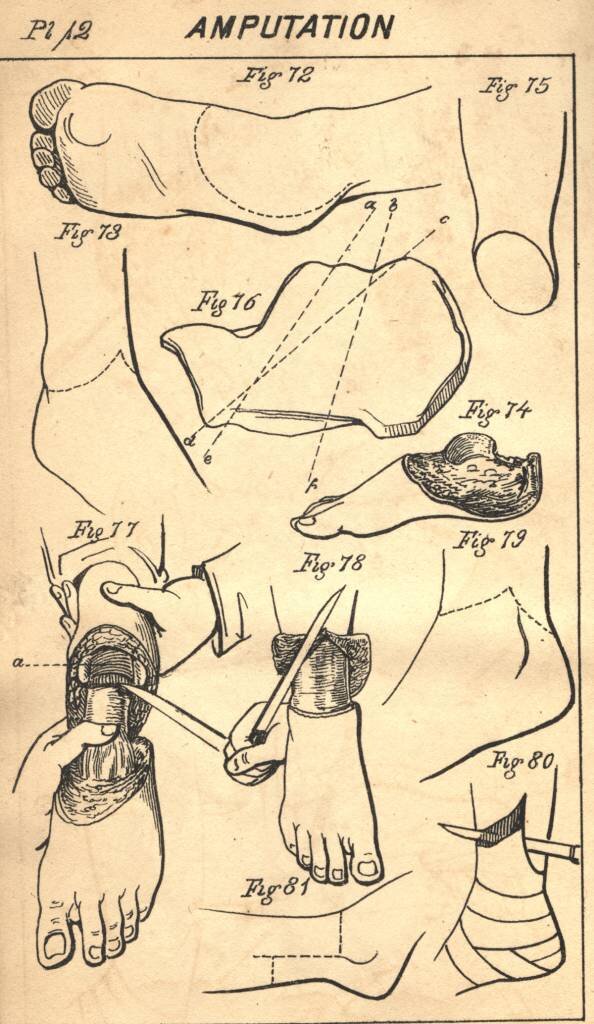 Amputation being performed in front of a hospital tent, Gettysburg, July 1863 Courtesy National Archives and Records Administration