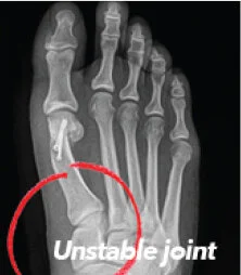 Traditional 2D Surgery "Cut & Shift" approach leaves an unstable joint