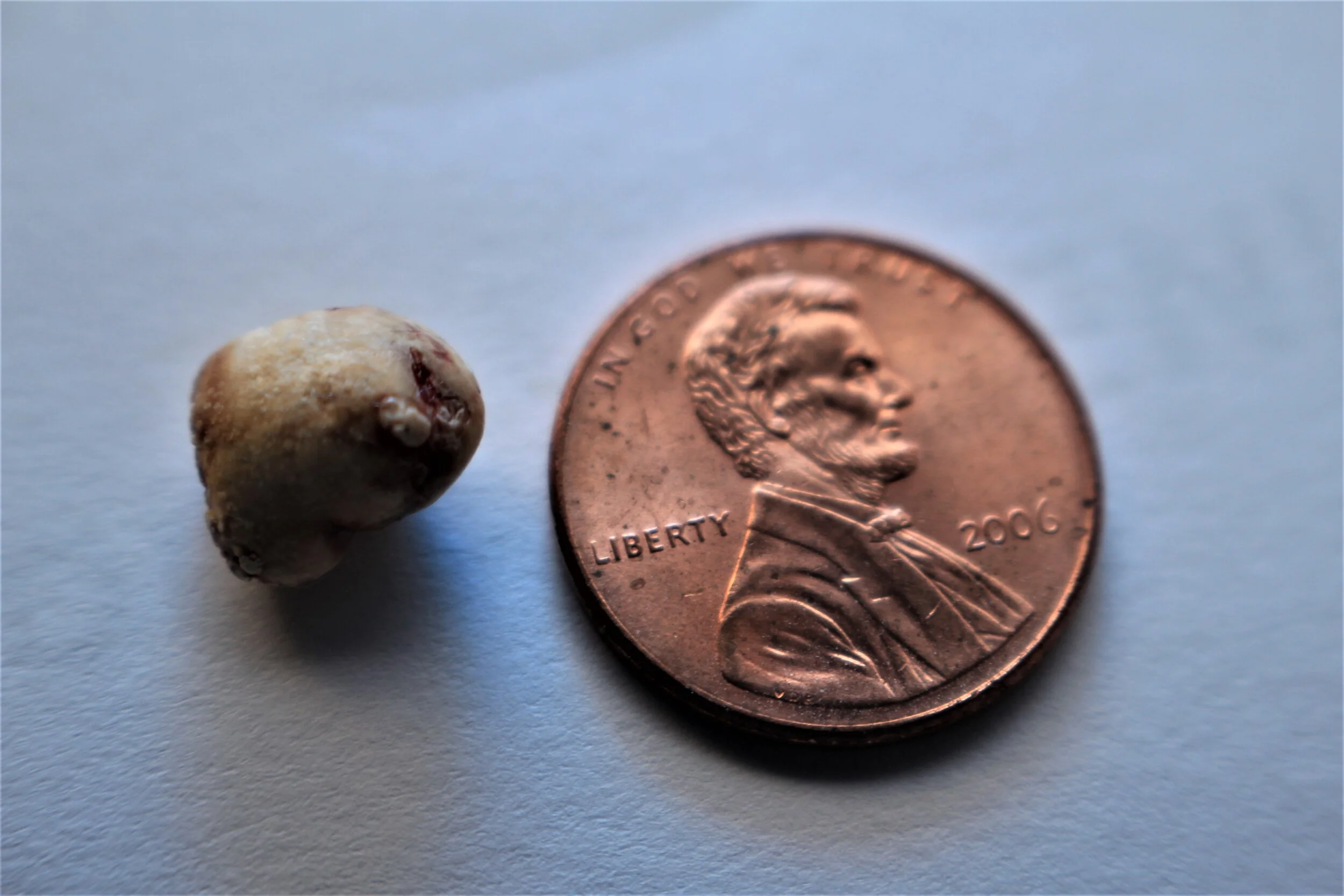 Steve's salivary stone with penny