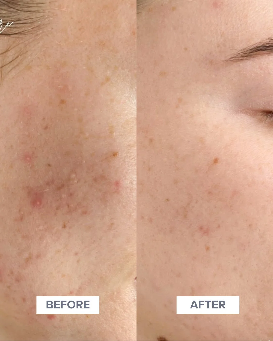 The PERFECT time to start a Chemical Peel series is right now! Get a few in prior to the holidays to wipe away summer pigment, acne, congestion, fine lines and surface texture. ⁠
⁠
Let's get you GLOWING for the holidays! ✨️