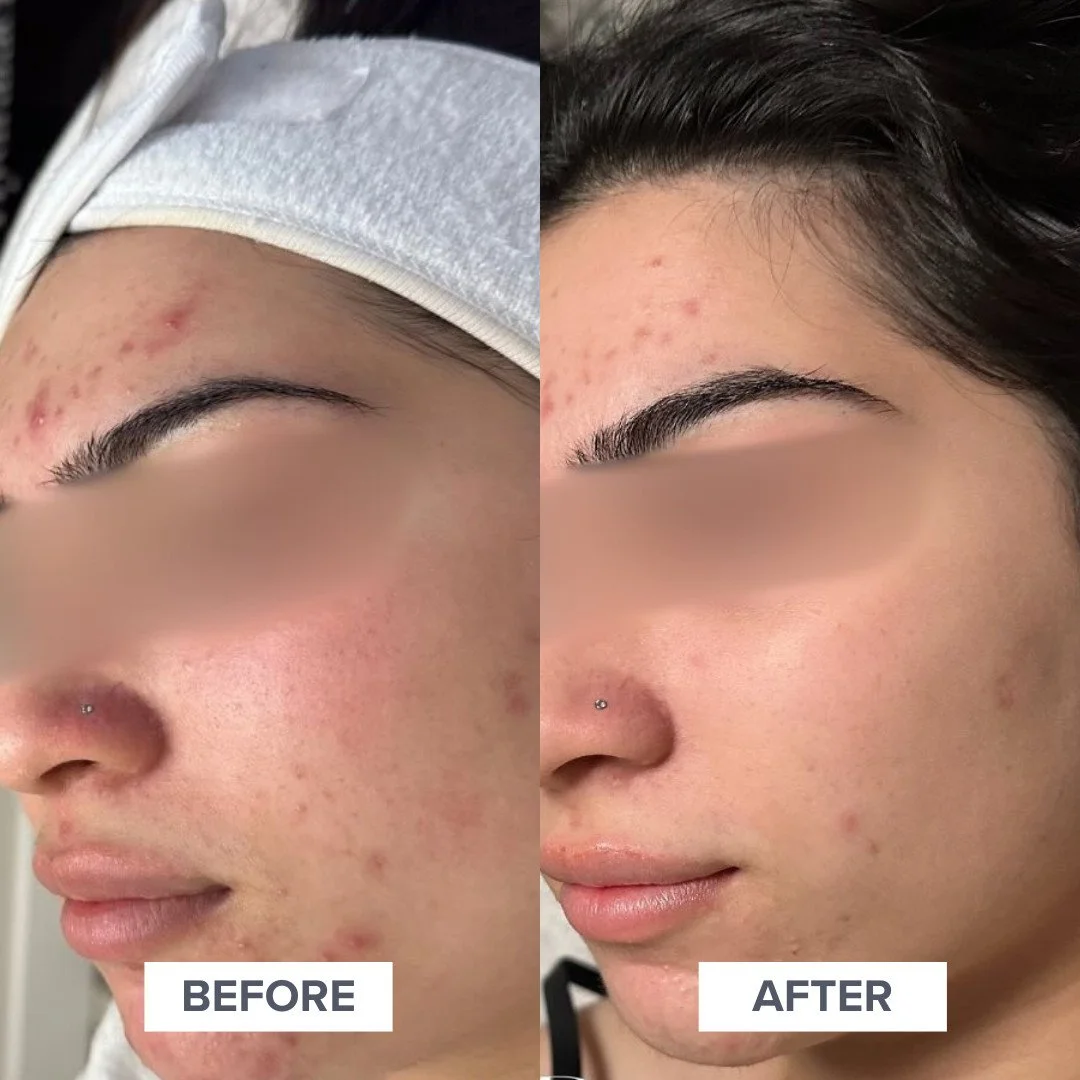 Chemical Peels are often the greatest reset for pigmented and/or acne prone skin. We use a wide range of chemical peels to lift hyperpigmentation, exfoliate surface layers, and decrease the visible signs of acne. ⁠
⁠
As long as your skin barrier is h