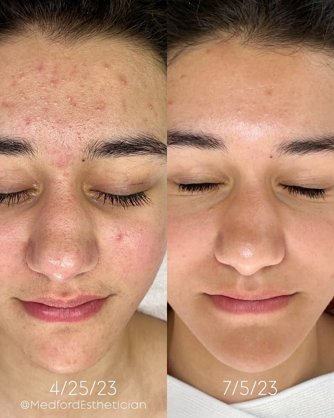I can never see these results enough...forever one of my favorite Before &amp; After results from just a few treatments combined with customized science-backed skincare! What an angel!⁠
⁠
⁠
⁠
______________________________⁠
⁠
🤍  BY APPOINTMENT ONLY⁠