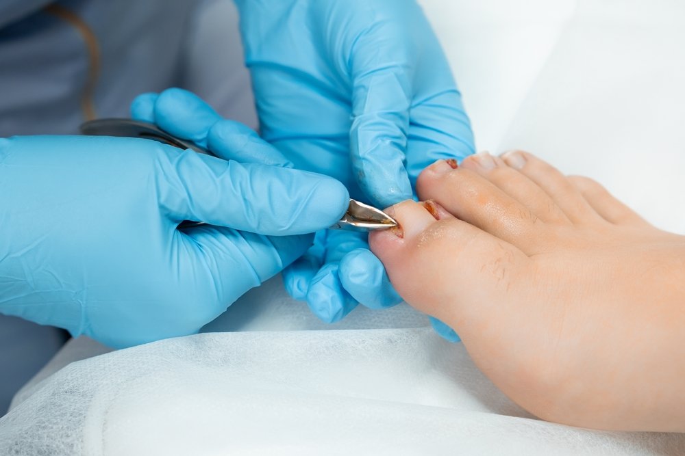 Nail Surgery: A Permanent Solution for Painful Ingrown Toenails