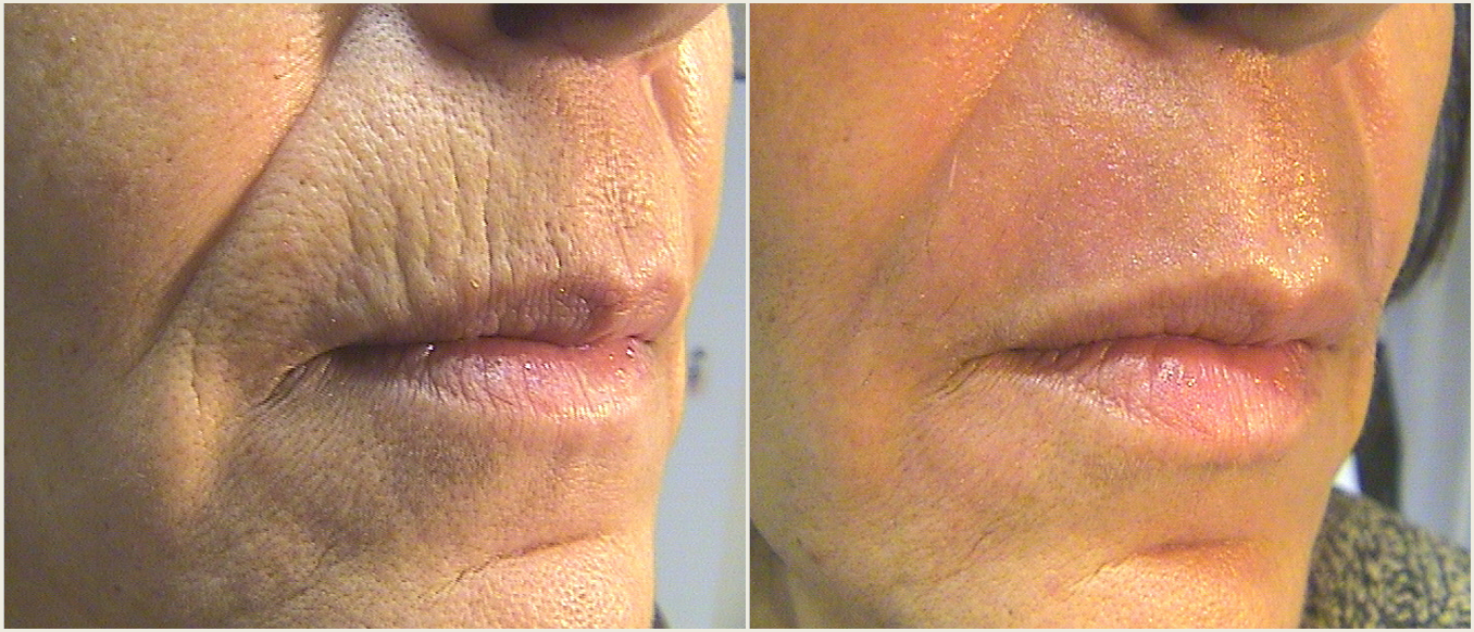 Tetra B&A Lip lines courtesy of Giovanni Cannarozzo, MD.png