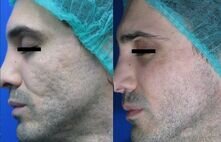 800-Acne scars B&A_Courtesy of Prof. G.Cannarozzo, Dermatology Dept. Tor Vergata University , Rome, Italy-800.jpg