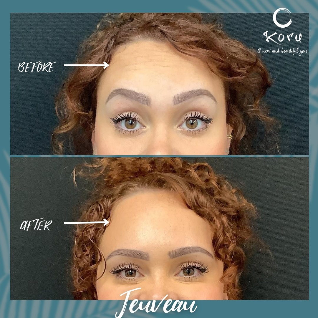 Minimizing wrinkles by minimizing movement! 

Relaxers are used to minimize the movement of the muscle which minimizing the appearance of fine line, wrinkles and texture. 

In both pictures, she is raising her eyebrows as high as possible. You can se