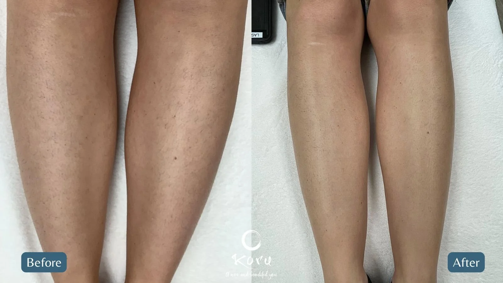 soprano_legs_before_after.jpg