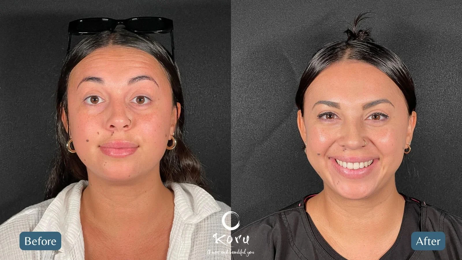 botox_teiana_before_after.jpg