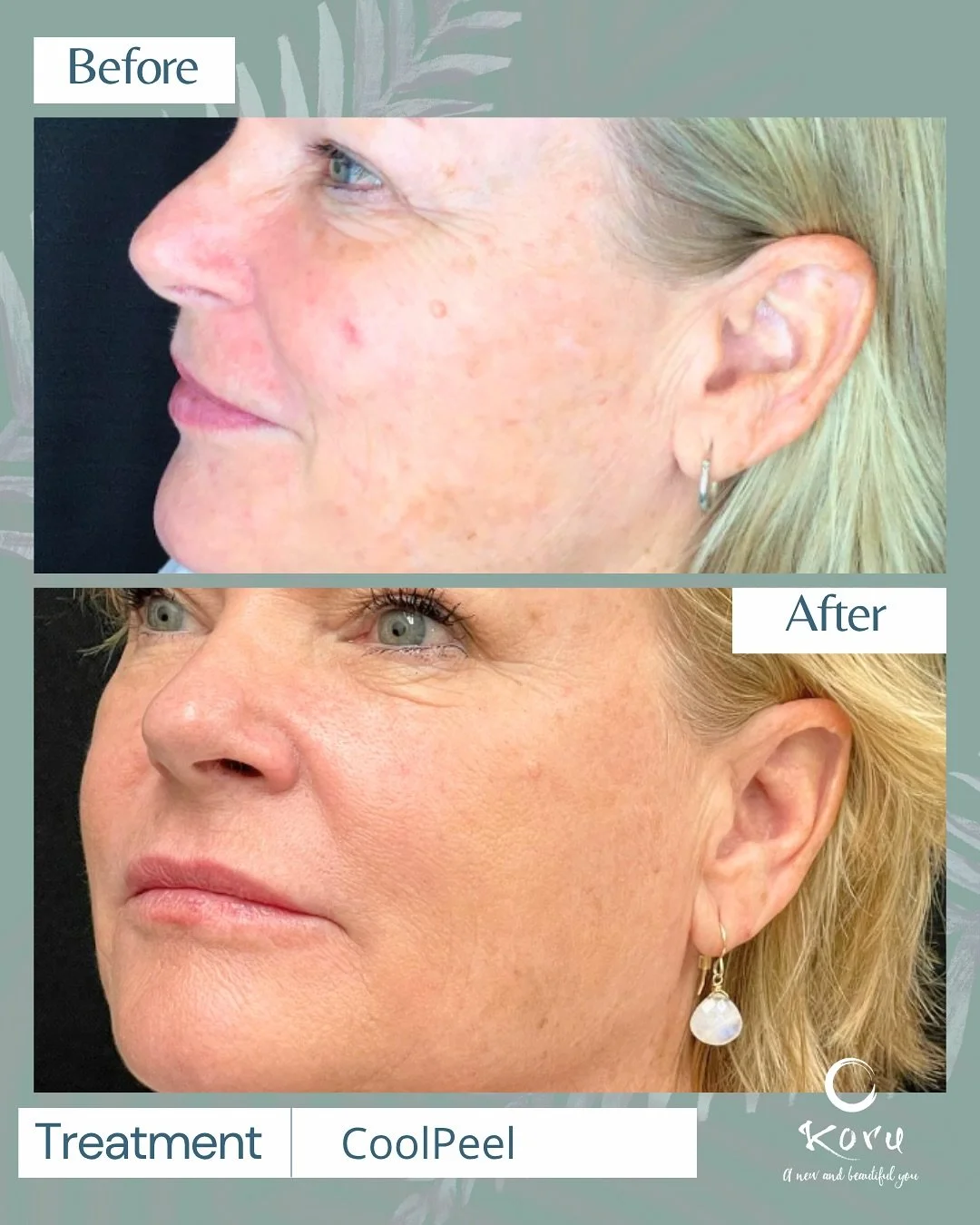 Smooth. Bright. Rejuvenated. ✨

Our CoolPeel laser is all about fresh, glowing skin with little downtime! 

This month only: 
🌿 Treat the face and neck and save $150!