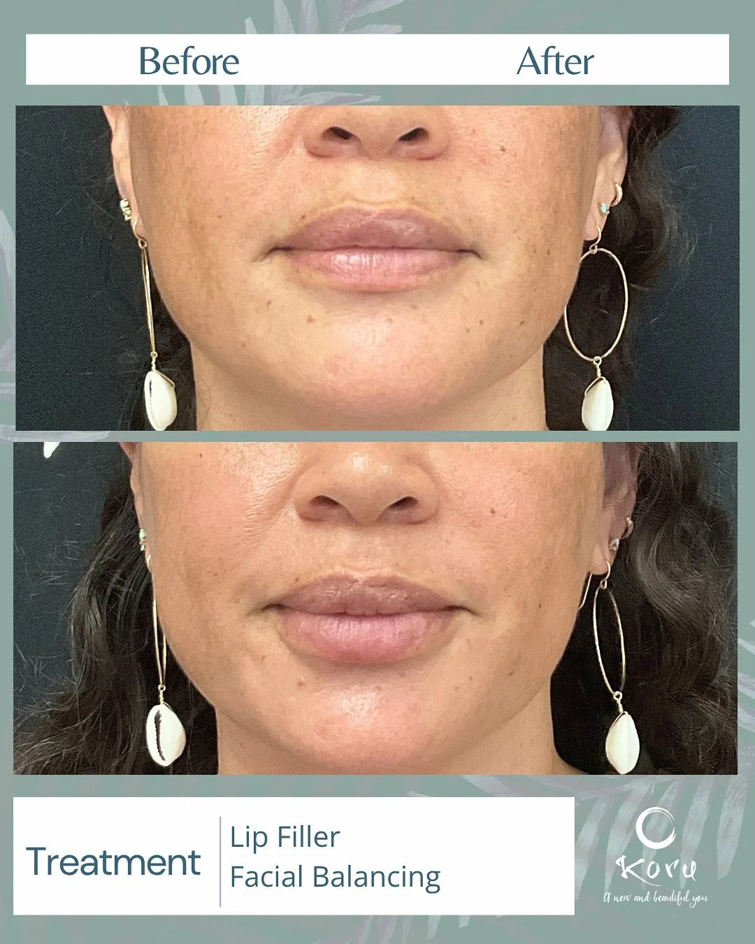 Just a little boost makes a big difference 💕

This beauty wanted more harmony between her top + bottom lips, so we focused filler on the lower lip for a soft, balanced finish. The result? Natural-looking fullness that keeps her features beautifully 