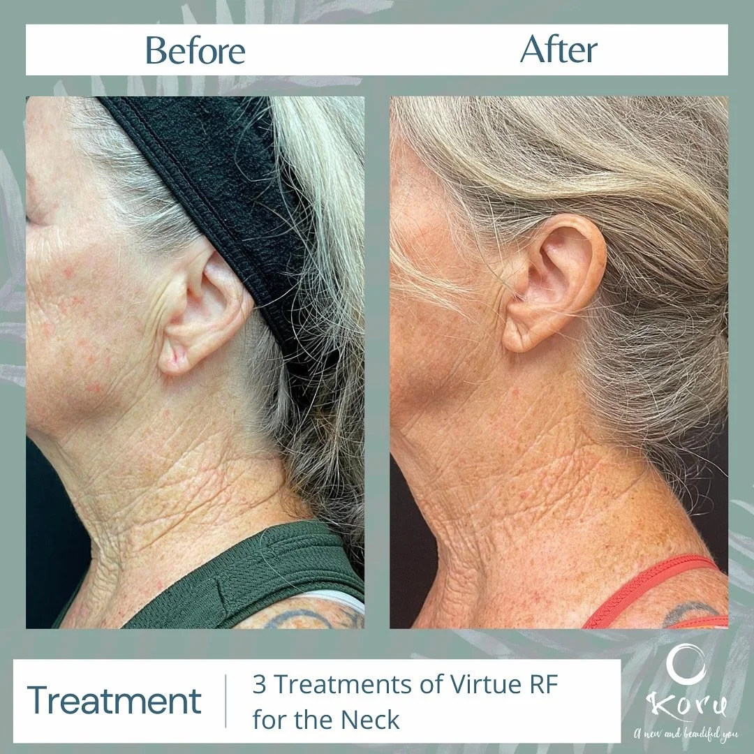 Why wait for Thanksgiving? Save the turkey neck and get ahead of the game with Virtue RF Microneedling for skin tightening and firming. Boost your results with DefenAge Neck Cream. All DefenAge products are 20% off this month!