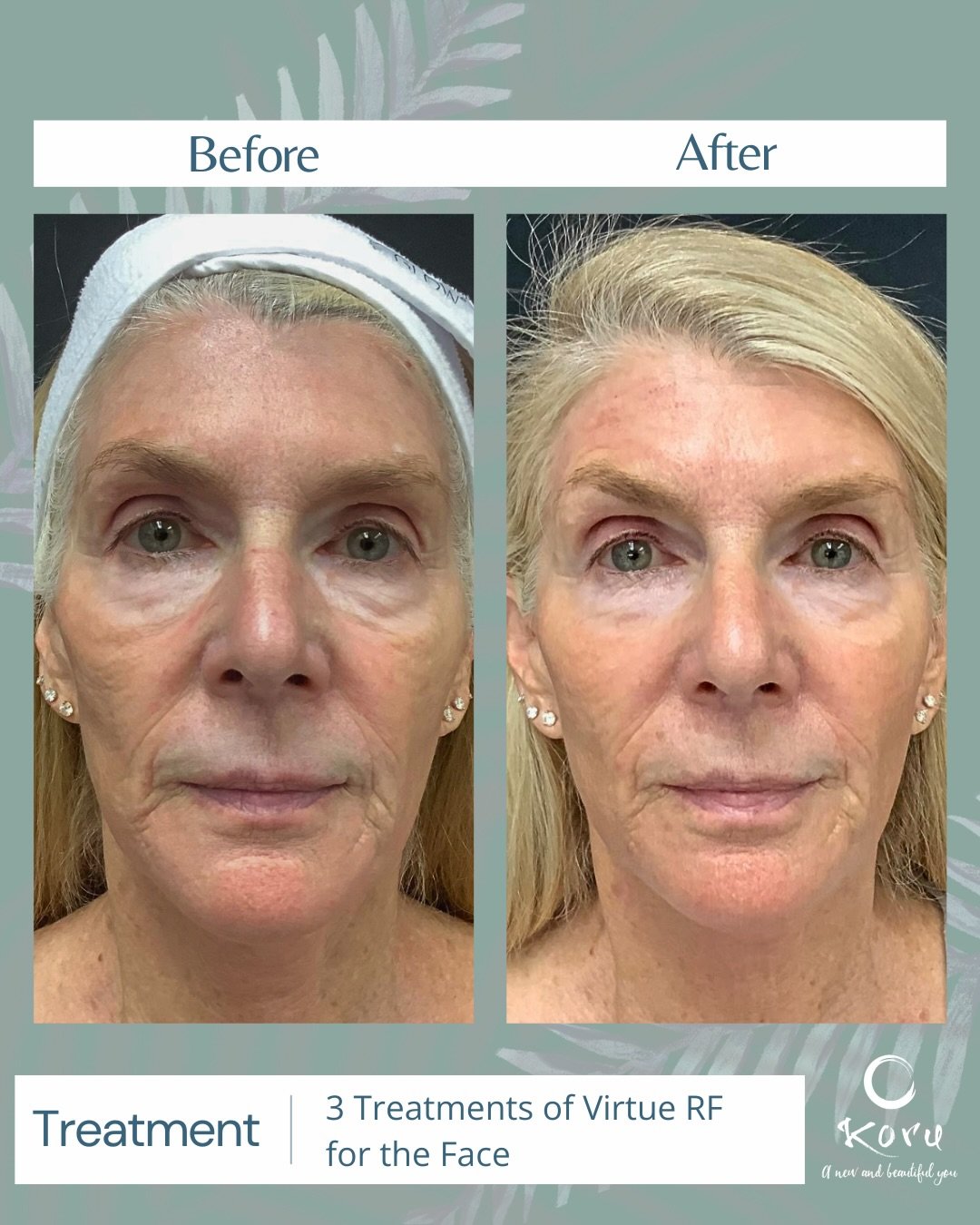 RF Microneedling is a powerhouse treatment for skin rejuvenation &mdash; and here&rsquo;s why 👇

🌿 Stimulates collagen + elastin by combining traditional microneedling with radiofrequency heat deep in the skin
🌿 Improves texture, fine lines, acne 