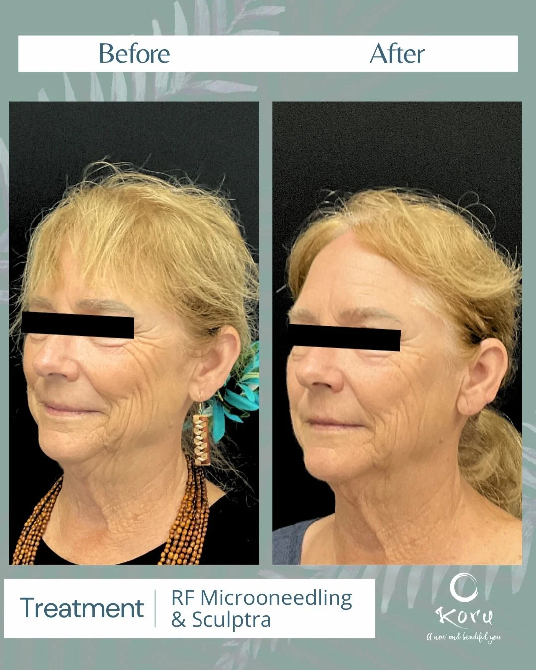 Talk about a powerhouse combo 😍
RF Microneedling + Sculptra work together to remodel, rebuild, and rejuvenate from the inside out.

✨ RF Microneedling tightens, improves texture, pores &amp; crepey skin
✨ Sculptra stimulates collagen for long-term f