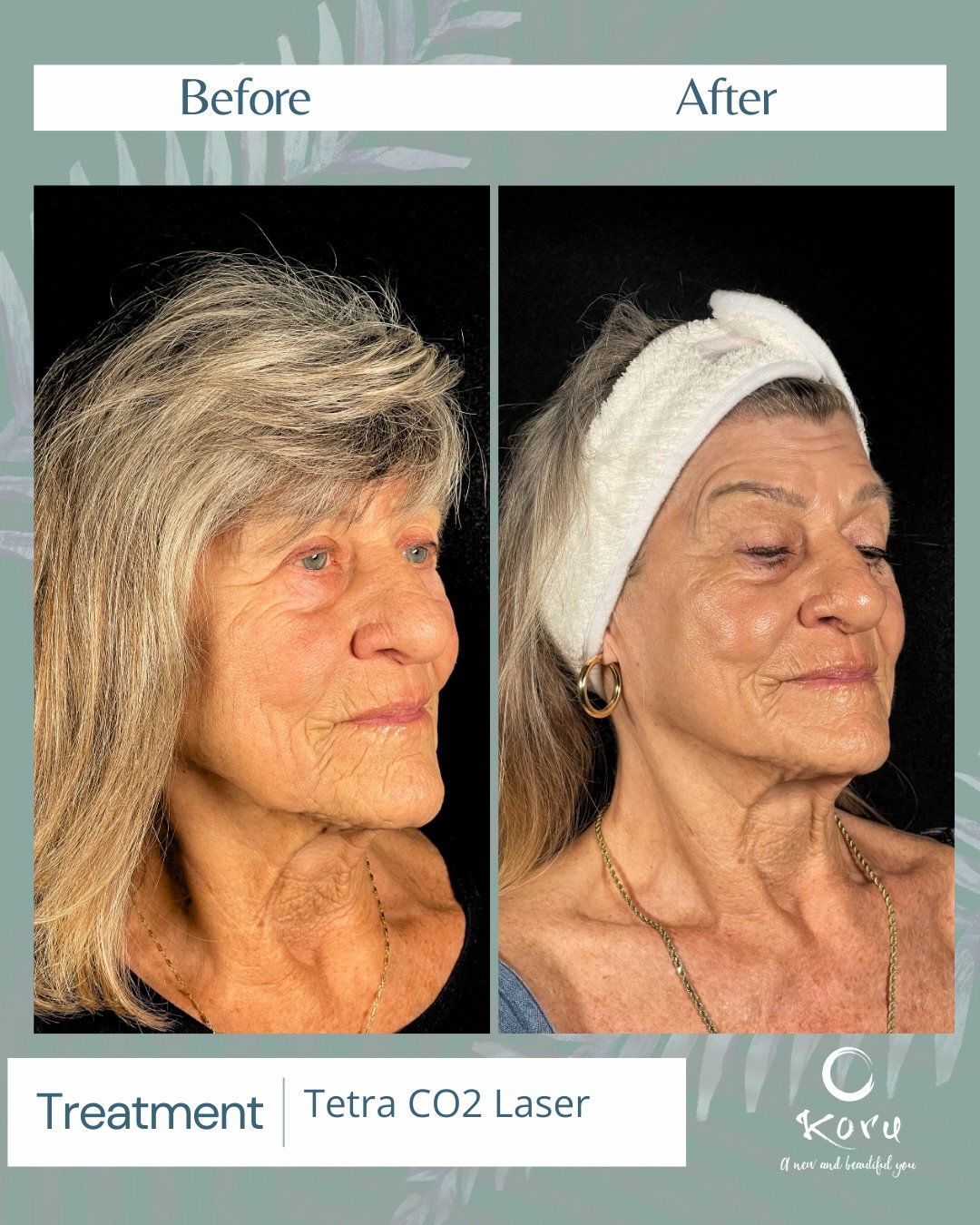 New skin loading&hellip; 🔥✨

These before + afters are from our CO2 laser resurfacing treatments &mdash; and yes, it just keeps getting better with time.

CO2 laser works by creating controlled micro-injuries in the skin, triggering collagen product