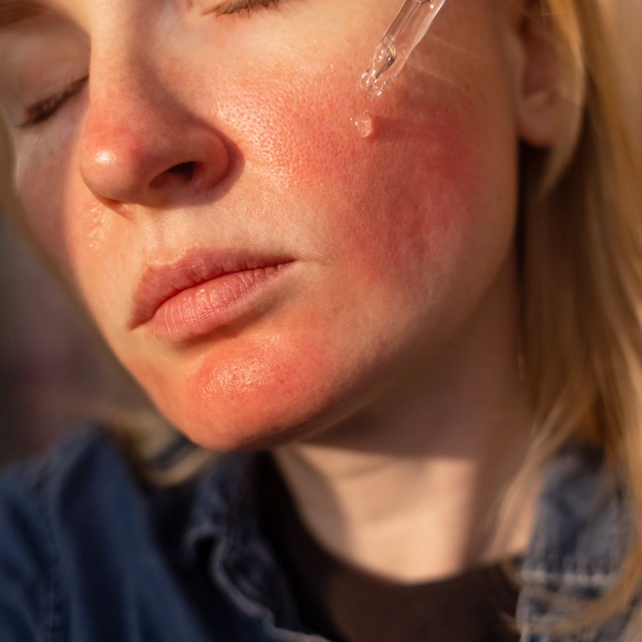 Rosacea: What Causes Facial Redness and How to Treat it Effectively