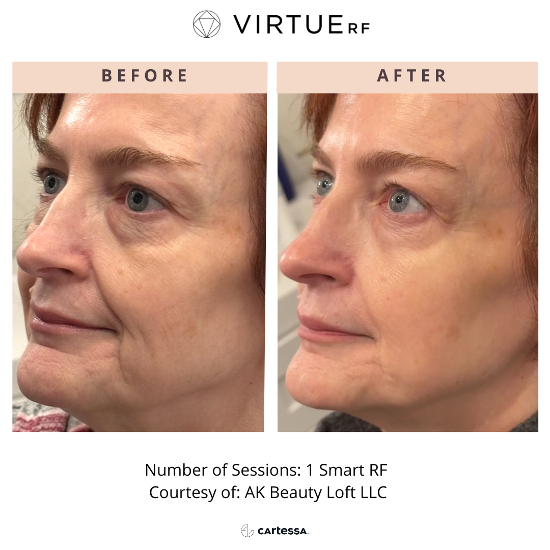 Before and after woman Virtue RF