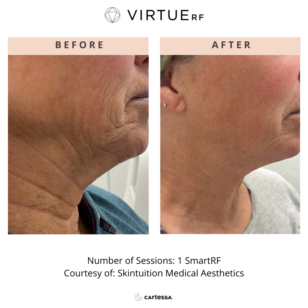 Neck before and after Virtue RF
