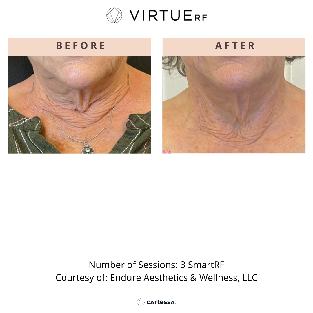 Neck before and after Virtue RF