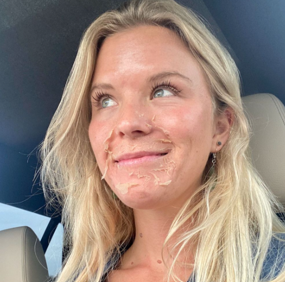 Chemical peel after 3 days