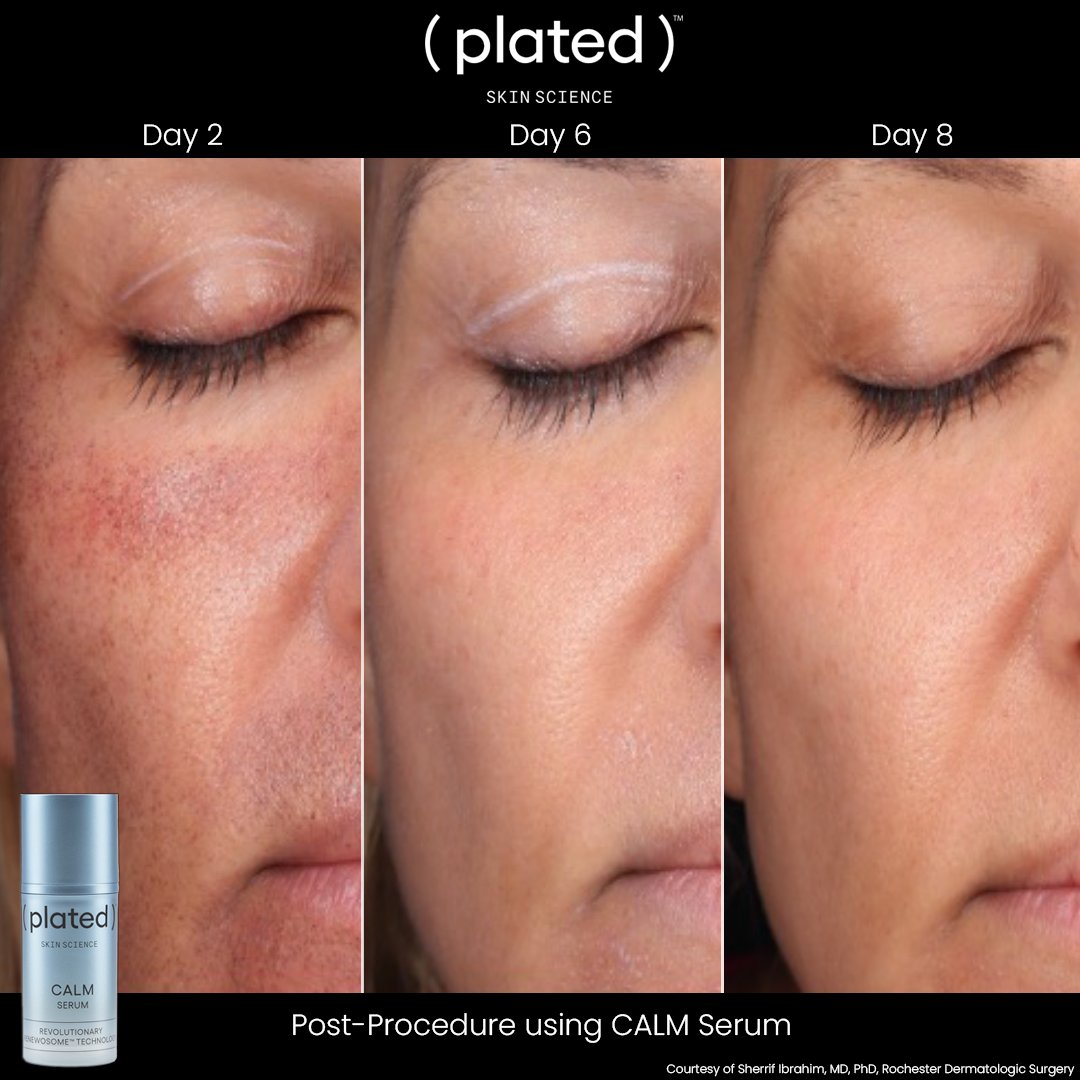 CALM Serum_Before + After.jpg