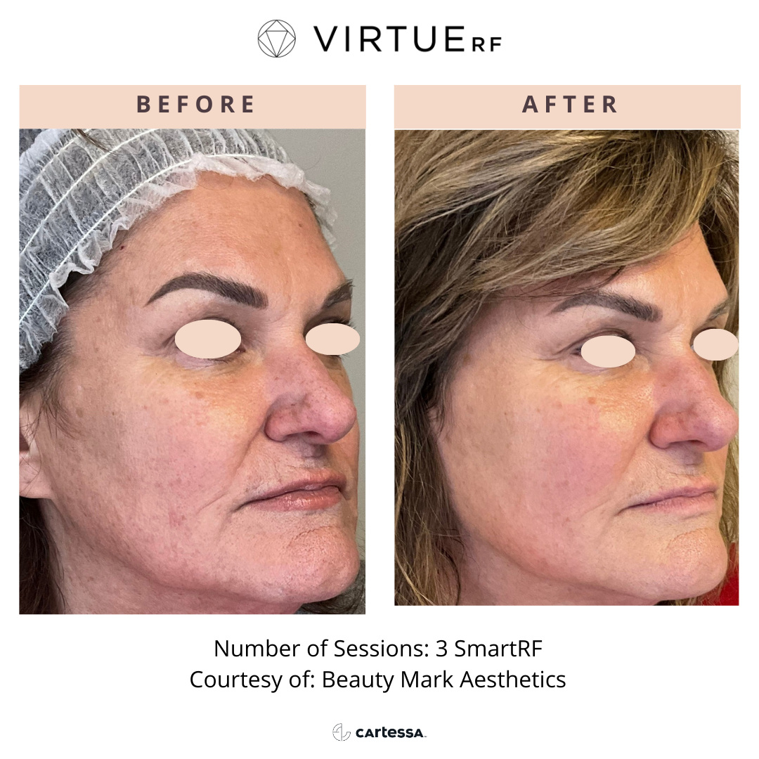 Woman before and after Virtue RF