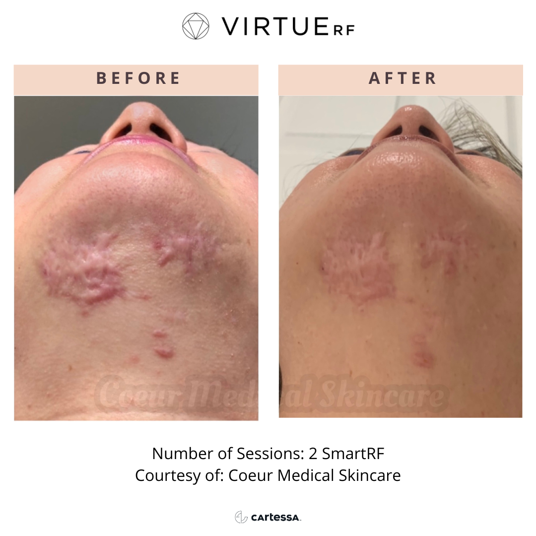 Chin scar before and After Virtue RF