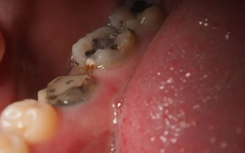  Pain After Dental Filling Prodent Has The Solution ProDent