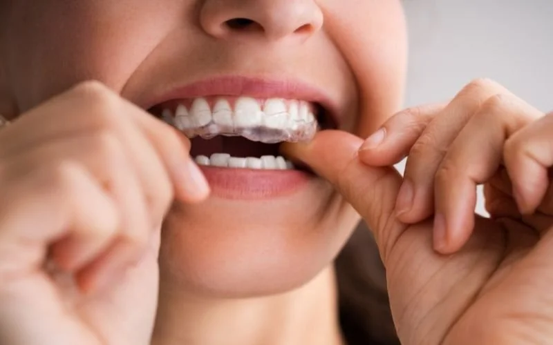 What are mouthguards and why should we use them?