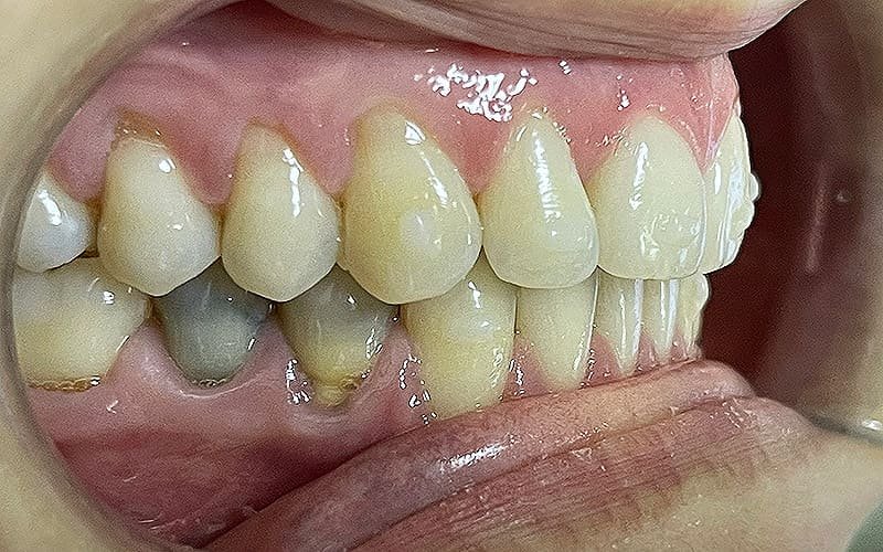 Invisalign-mx.jpg