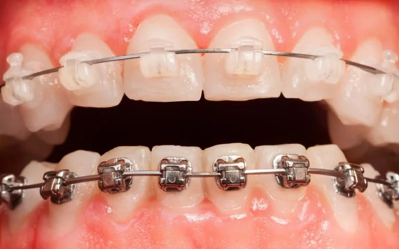 Metal braces VS. Sapphire braces: Which is the most effective for correcting your smile?