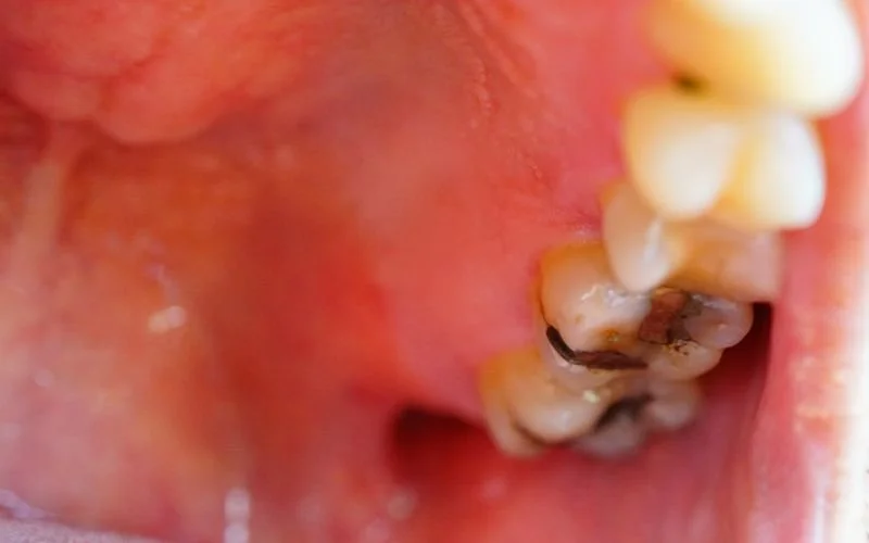 "Pain after dental filling? Prodent has the solution" — ProDent