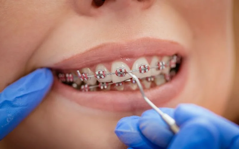 Orthodontics in Tijuana
