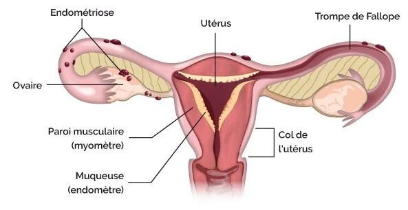 endometriose morgane michaux ostéopathe venelles .jpg