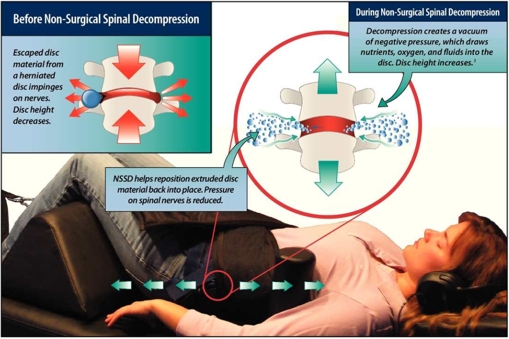 Spinal Decompression Covington LA