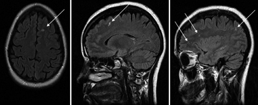 Brain-MRI-of-a-patient-with-frequent-migraines-who-had-white-matter-lesions-Arrows.png