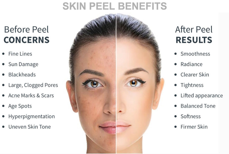 Peel-Results.jpg