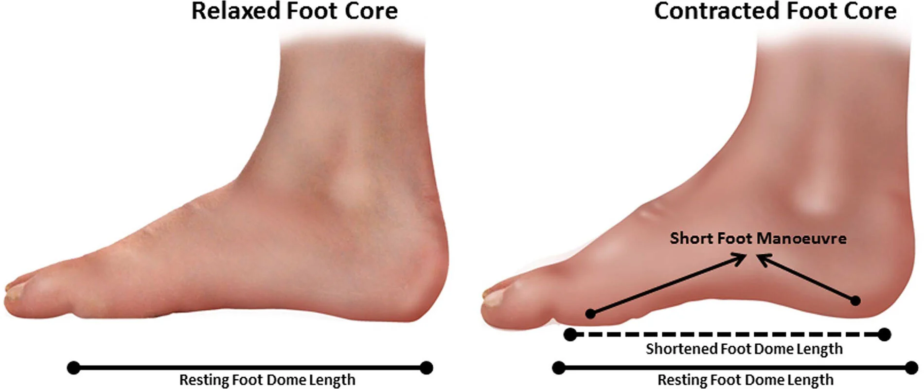 Figure 2 The foot is ‘shortened’ or “domed by using the intrinsic muscles to pull the medial, transverse and lateral arch arches of the foot into a dome or parachute type structure.