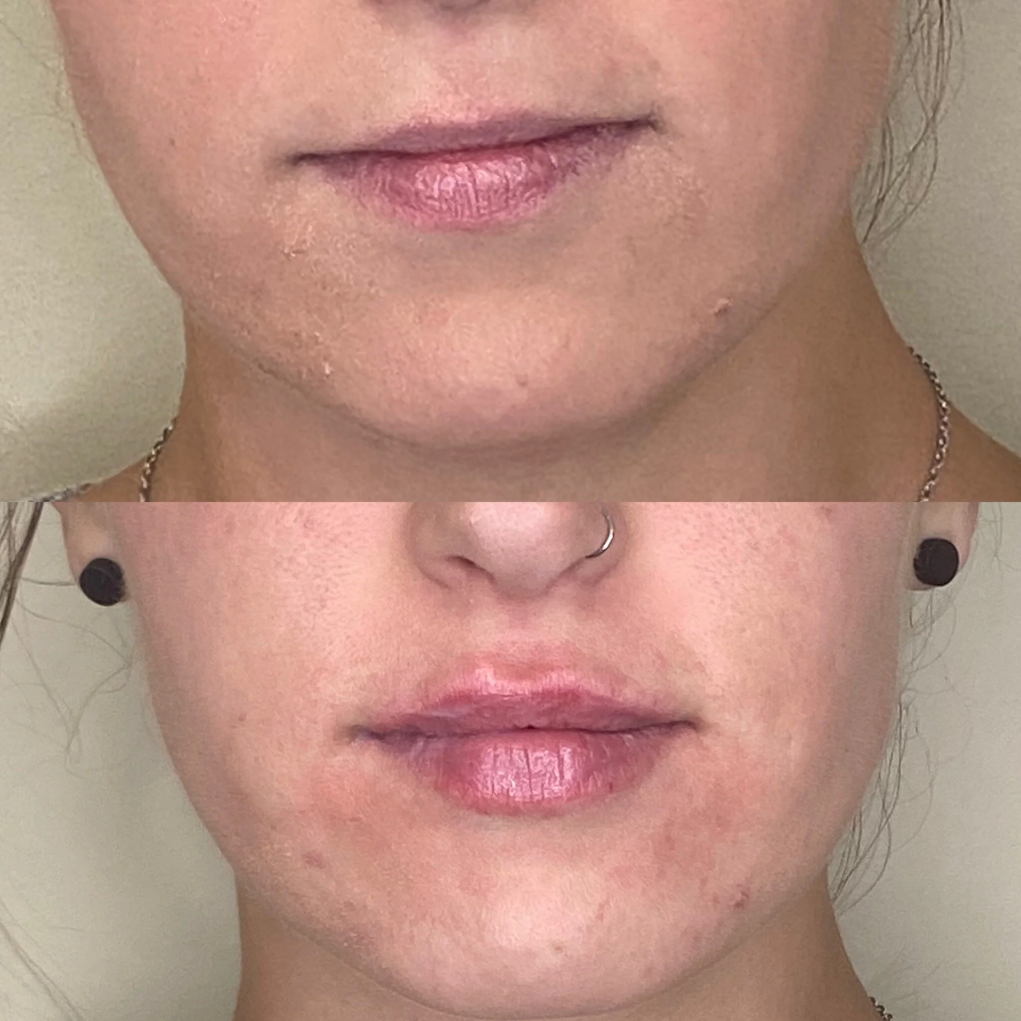 1/2 syringe lip filler