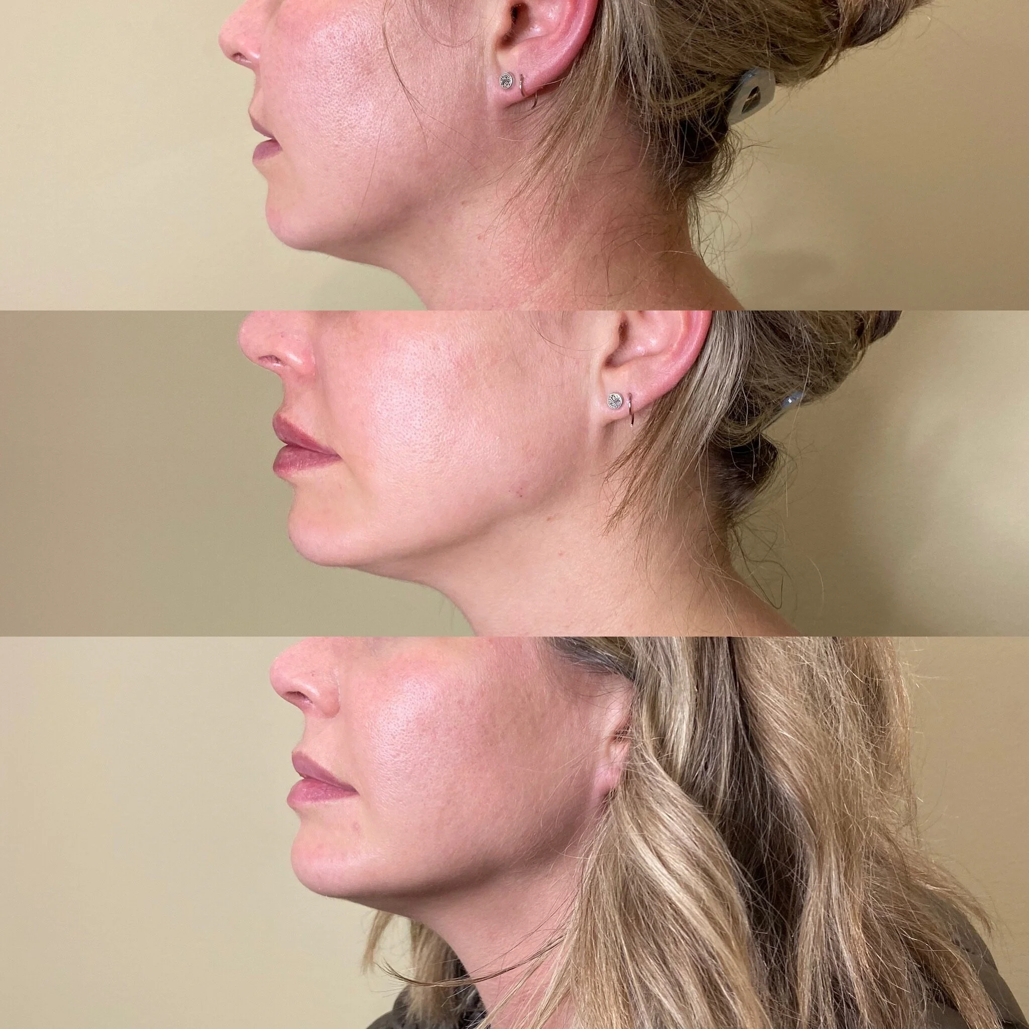  jaw line and chin filler 