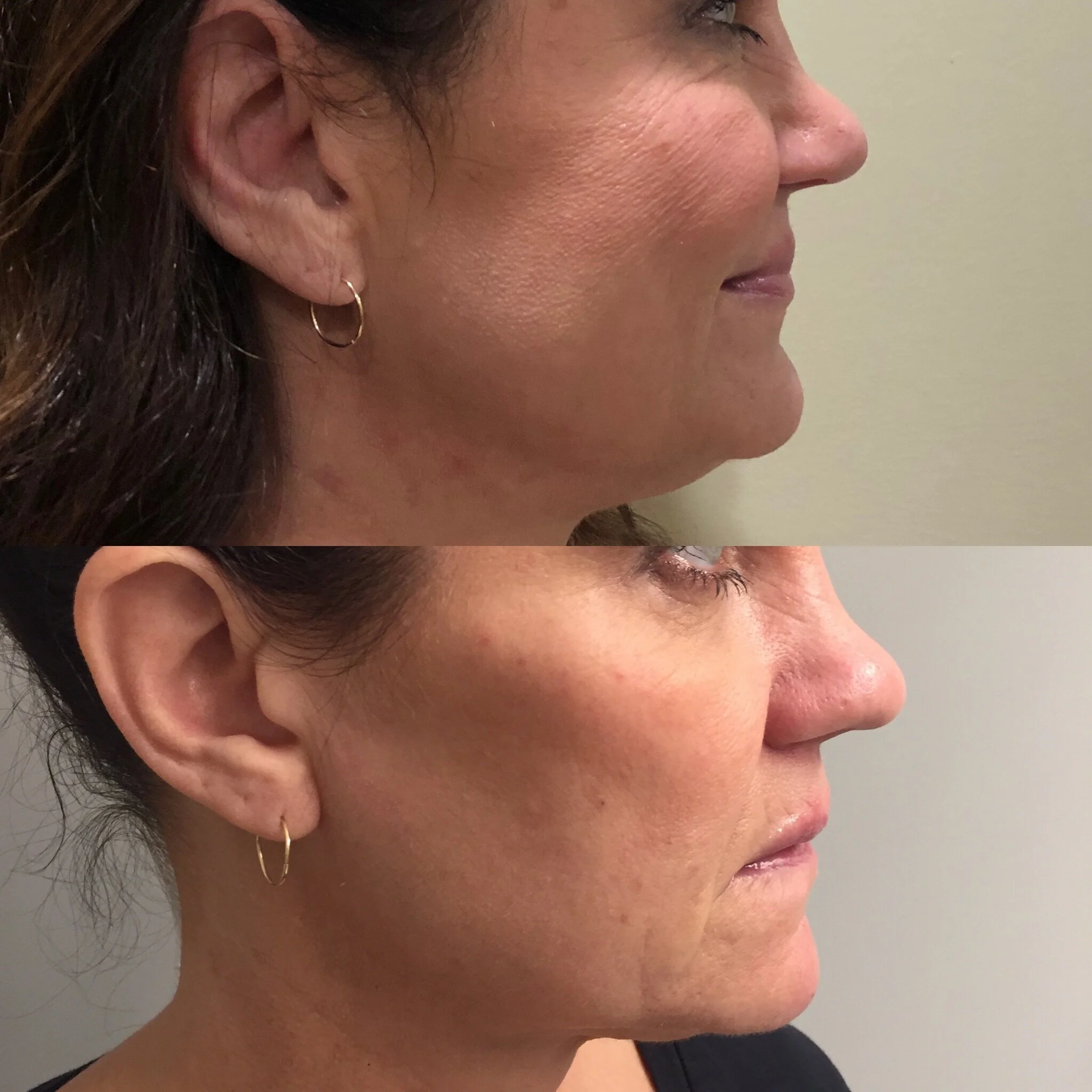  cheek and chin filler 