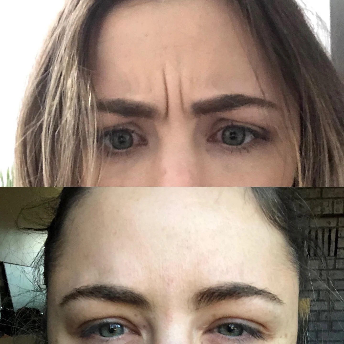  frown line neuromodulator 