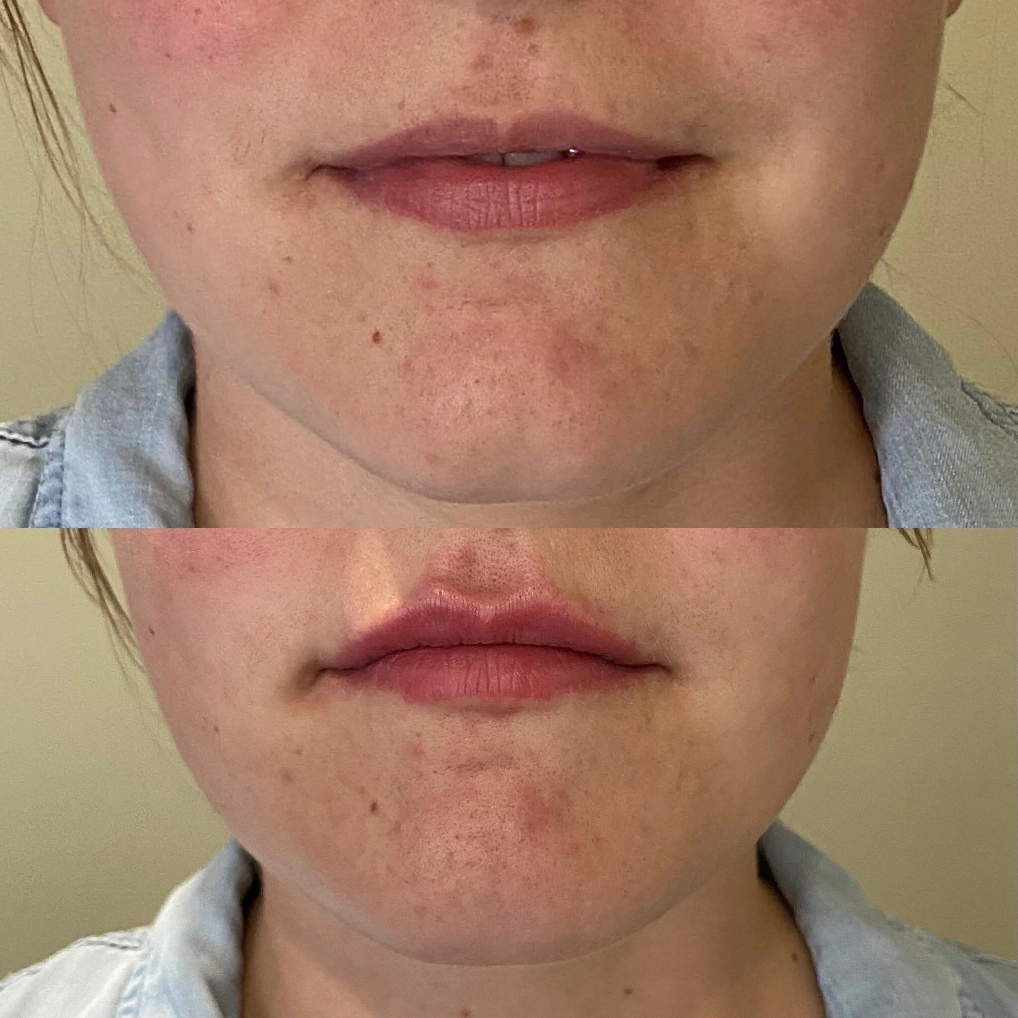  1/2 syringe of lip filler 